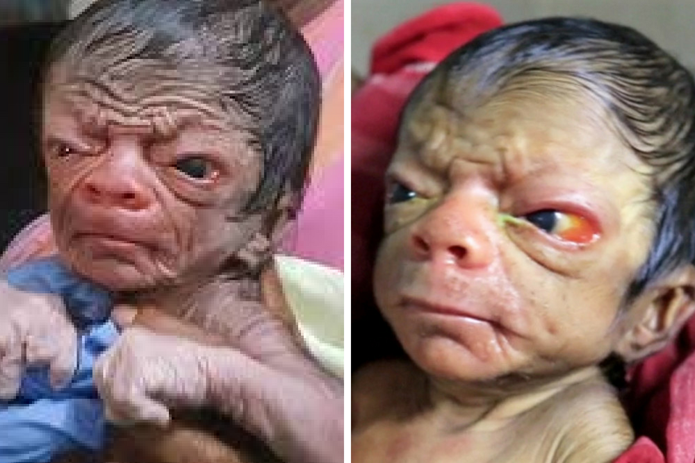 progeria co to, progeria, nietypowy noworodek