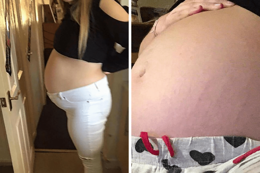 lirsty butler, torbiel jajnika, kobieta w ciąży, poronienie przyczyny