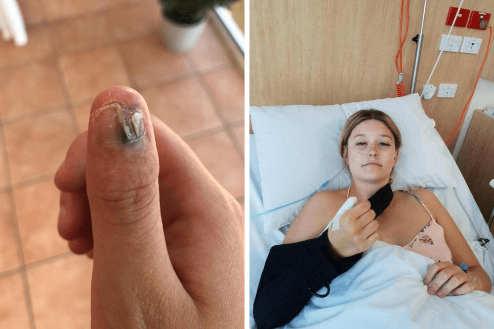 obgryzanie paznokci, czerniak, amputacja palce, skutki obgryzania paznokci