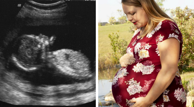 kelsey huslet, ciąża bliźniacza, ciąża mnoga, nietypowa ciaża