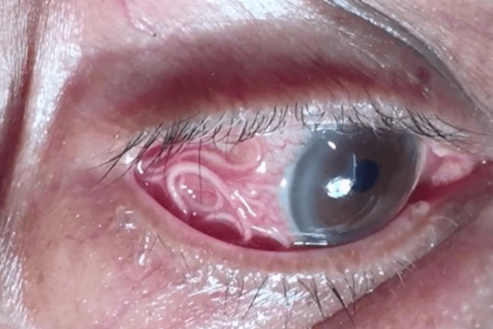 pasożyt w oku, nicień, operacja